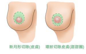 提乳手術(shù)2.jpg