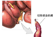 闌尾手術(shù)會影響結(jié)腸嗎？闌尾手術(shù)術(shù)后要注意什么？