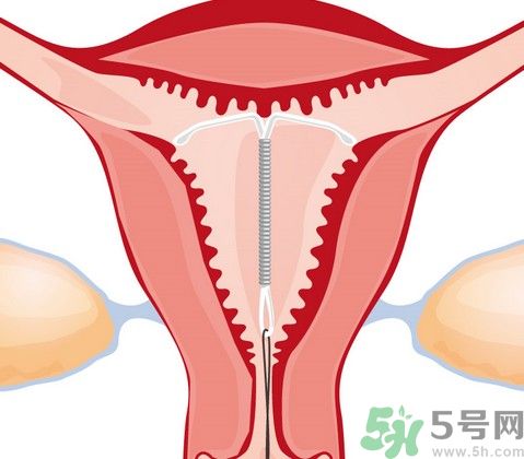 避孕環(huán)是什么?避孕環(huán)的危害和副作用