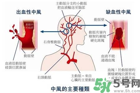 腦中風是什么？腦中風的癥狀？