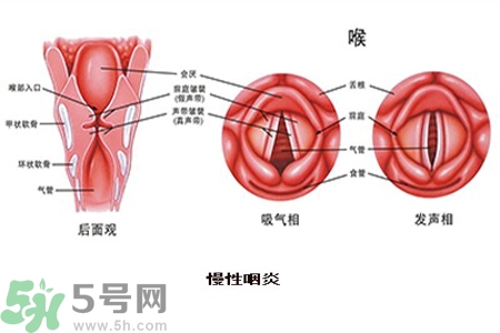 慢性咽炎是什么？慢性咽炎的癥狀有哪些？