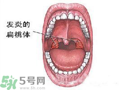 慢性咽炎是什么？慢性咽炎的癥狀有哪些？