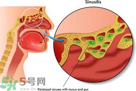 鼻竇炎的護(hù)理措施？鼻竇炎的飲食護(hù)理？