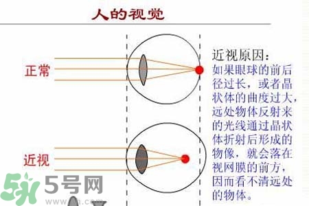 近視眼的發(fā)病因素？近視眼的并發(fā)癥有哪些？