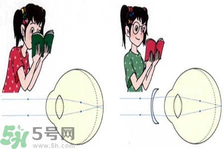 近視眼的發(fā)病因素？近視眼的并發(fā)癥有哪些？