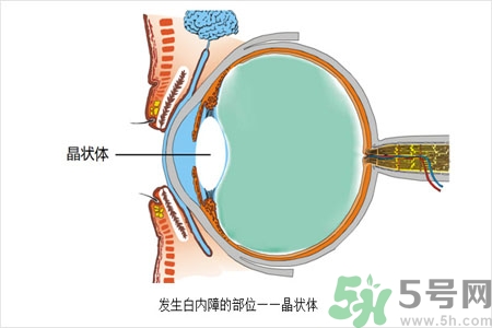 白內(nèi)障的護(hù)理措施是什么？白內(nèi)障的飲食護(hù)理有哪些？