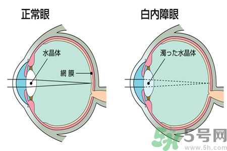 白內(nèi)障的發(fā)病因素是什么？白內(nèi)障并發(fā)癥有哪些？