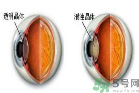 白內(nèi)障治療方法是什么？白內(nèi)障可以用什么藥物治療？