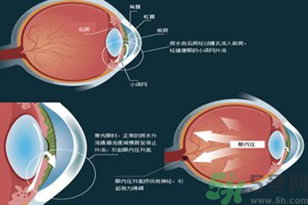 青光眼是什么？青光眼癥狀有什么？