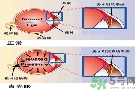 青光眼的護(hù)理措施有什么？青光眼的飲食護(hù)理有哪些？