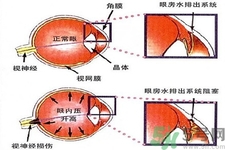 青光眼的發(fā)病因素是什么？青光眼的并發(fā)癥有哪些？