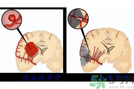 腦出血的發(fā)病因素是什么？腦出血的并發(fā)癥有哪些？