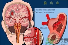 腦出血的發(fā)病因素是什么？腦出血的并發(fā)癥有哪些？