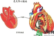 心臟病的癥狀是什么？心臟病的種類有哪些？