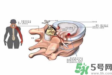 為什么年輕人容易得頸椎病？頸椎病嚴(yán)重的癥狀有哪些？