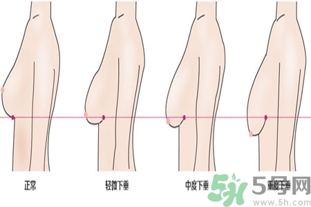 ?女性乳房下垂的原因是什么？女性乳房下垂的分類有哪些？