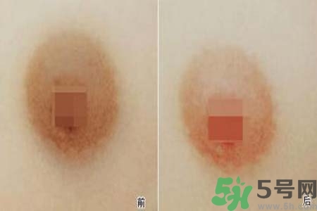 乳頭發(fā)黑怎么辦？怎么樣可以使乳頭變白？