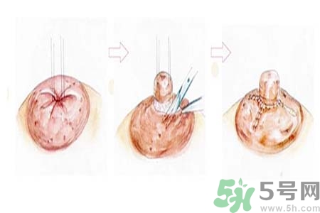 乳頭內(nèi)陷怎么回事？乳頭內(nèi)陷的原因是什么？