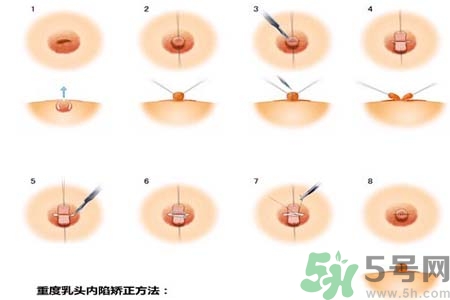 乳頭內(nèi)陷怎么回事？乳頭內(nèi)陷的原因是什么？