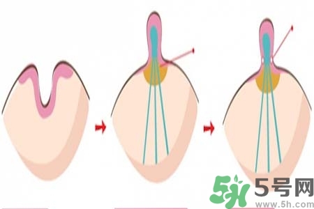 乳頭內(nèi)陷怎么辦？乳頭內(nèi)陷的癥狀有哪些？