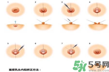 乳頭內(nèi)陷怎么辦？乳頭內(nèi)陷的癥狀有哪些？