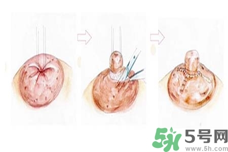 乳頭內(nèi)陷怎么辦？乳頭內(nèi)陷的癥狀有哪些？