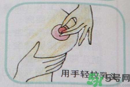 乳頭內(nèi)陷怎么辦？乳頭內(nèi)陷的癥狀有哪些？