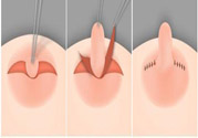 乳頭內(nèi)陷怎么辦？乳頭內(nèi)陷的癥狀有哪些？