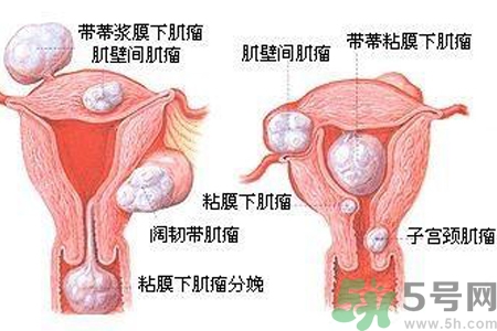 ?子宮移位怎么治療？子宮移位能懷孕嗎？