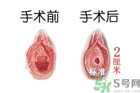 什么人不能做處女膜修補術？處女膜修補術會留疤嗎？