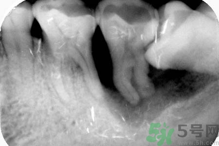 拔智齒一顆多少錢？拔除智齒收費(fèi)多少？