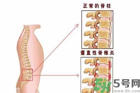 僵直性脊椎炎的癥狀有哪些？怎樣預防僵直性脊椎炎？