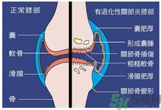 骨關(guān)節(jié)炎能治好嗎？骨關(guān)節(jié)炎平時(shí)注意事項(xiàng)