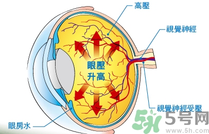 青光眼可以治愈嗎？青光眼怎樣治療？