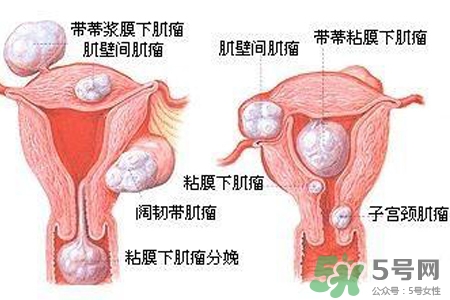 子宮小會(huì)影響生育嗎？子宮小會(huì)導(dǎo)致不孕嗎？