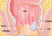 怎樣辨別外痔和內(nèi)痔？外痔和內(nèi)痔的區(qū)別