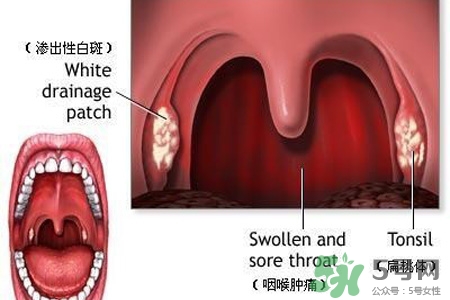 咽喉炎吃什么藥最好？咽喉炎吃什么藥好的快？