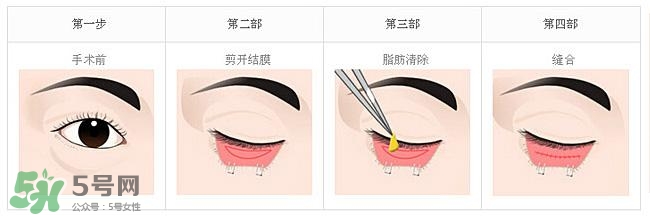 眼袋是怎么形成的？手術(shù)去眼袋安全嗎