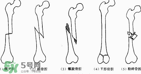 骨折吃什么好得快？骨折后注意事項(xiàng)