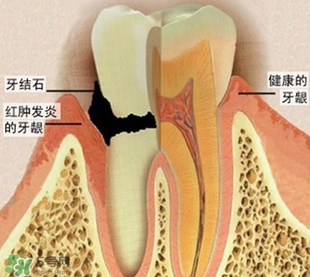 牙結(jié)石是什么？牙結(jié)石圖片