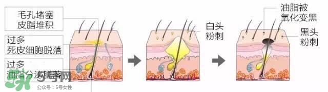 鼻子長黑頭是因為什么原因 如何找到適合自己的去黑頭方法