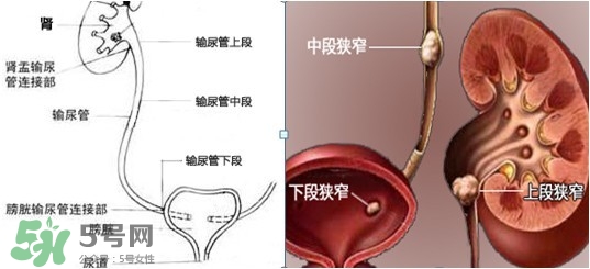 腎結(jié)石怎么治最好？腎結(jié)石的醫(yī)治方法