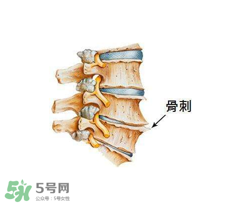 骨刺是怎么形成的？骨刺怎么治療？