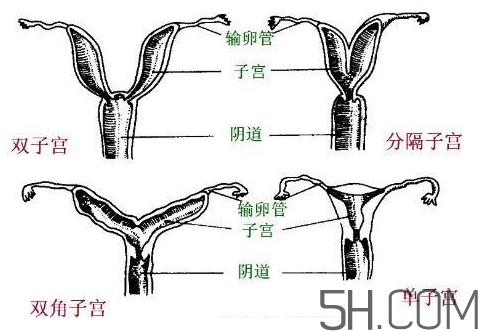 子宮畸形有哪些？子宮畸形有什么影響？