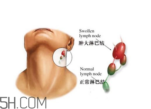 淋巴癌能活多久？淋巴癌癥狀有哪些