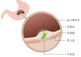 幽門螺桿菌的癥狀有哪些表現(xiàn)？幽門螺旋菌怎么治療