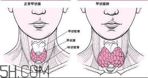 甲狀腺結(jié)節(jié)與甲狀腺腫瘤的區(qū)別有哪些？甲狀腺結(jié)節(jié)可以艾灸嗎