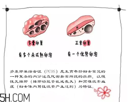 多囊卵巢生不了？多囊卵巢懷孕要看準(zhǔn)時(shí)間