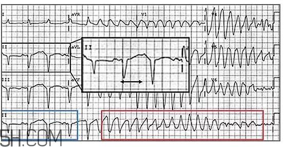 心電圖怎么看？6種常見心電圖異常情況