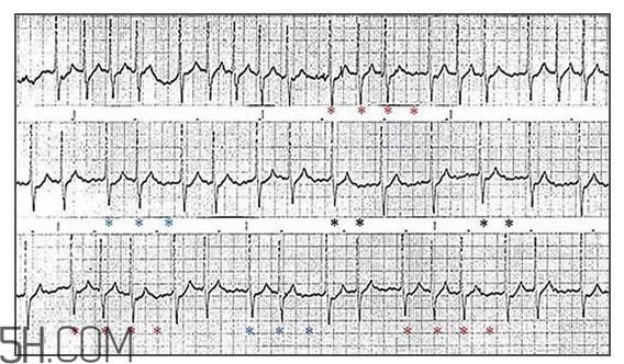 心電圖怎么看？6種常見心電圖異常情況